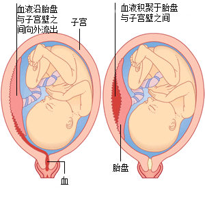 左侧为显性胎盘早剥，右侧为隐形胎盘早剥